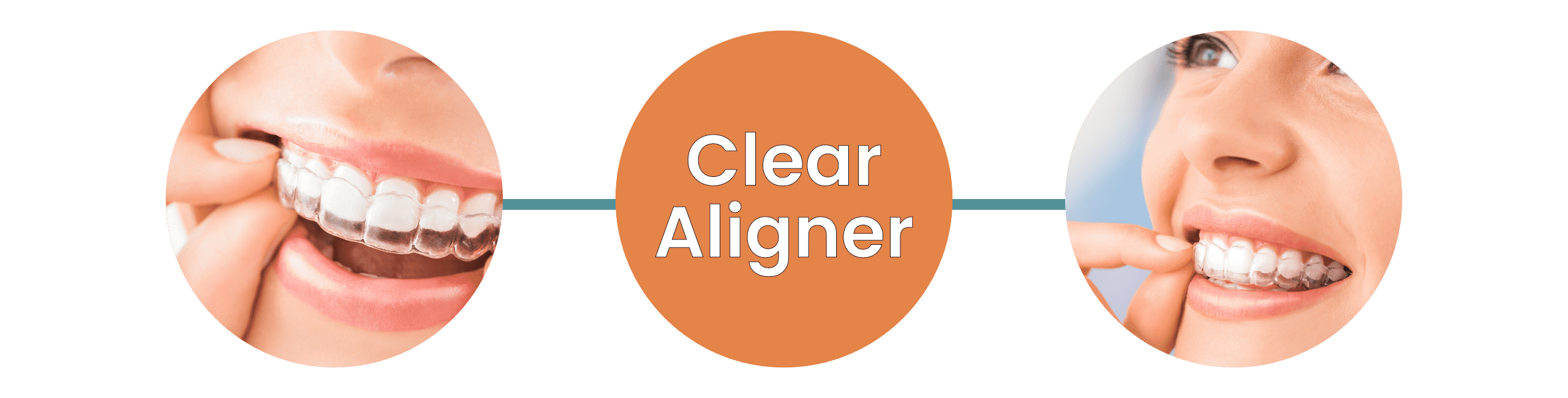 Spark Clear Aligners