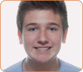 Cole after braces head shot