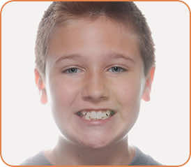 Cole before braces head shot