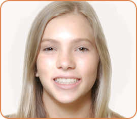 Lindsay after braces head shot