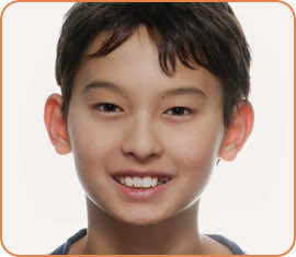 Mitchell before braces head shot