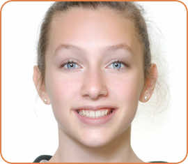 Elenora after braces head shot