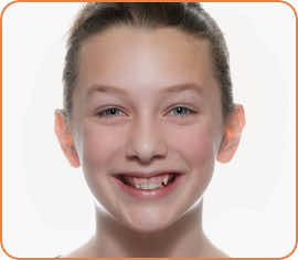 Elenora before braces head shot