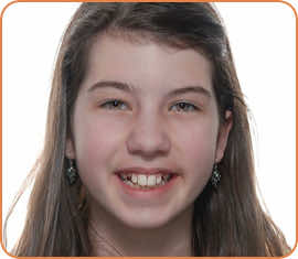 Eva before braces head shot